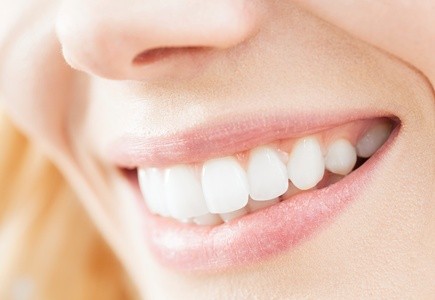 Up to 35% Off on Teeth Whitening - Traditional at Leveauxs Spa Experience