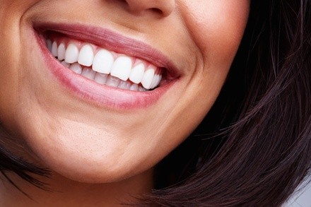 Up to 42% Off on Teeth Whitening - Traditional at All Smiles Teeth Whitening