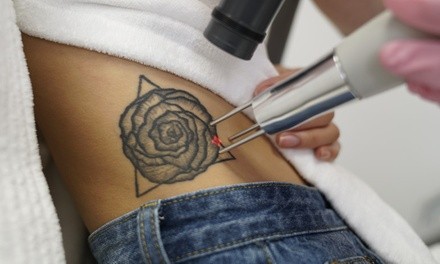 Three Laser Tattoo Removal Sessions at LaserAway(Up to 84% Off). Three Options Available.