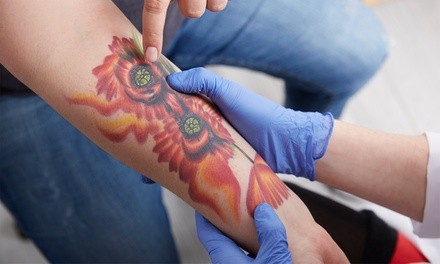 One Laser Tattoo-Removal Session on an Area up to Four or Eight Square Inches at Fade Away Laser (Up to 77% Off)