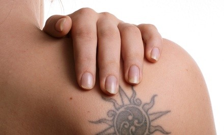 Three Tattoo-Removal Sessions on an Extra-Small, a Small, or a Medium Area at VanishMD (Up to 80% Off)