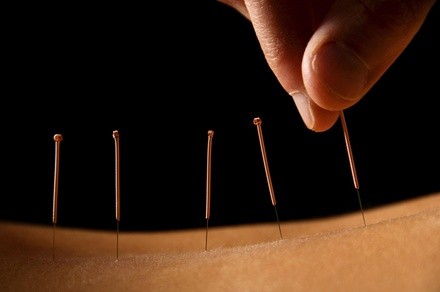 $65 Worth of Acupuncture