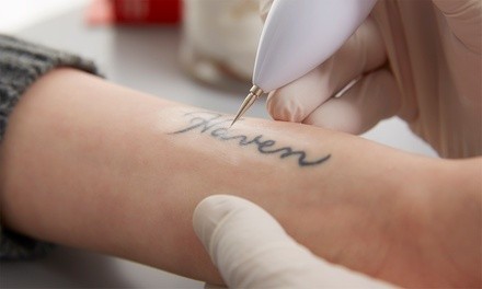 $139 for Three Laser Tattoo-Removal Sessions for a  2”x2” Area at LaserTouch Aesthetics ($600 Value)
