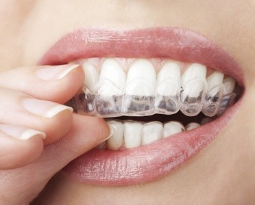 $39.20 for $7,000 Towards a Complete Invisalign Package and Consultation at Mission Dental