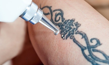 Laser Tattoo Removal on Up to Four or Eight Sq.Inch-Area at LaserALL (Up to 75% Off)
