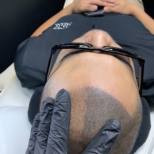 Up to 46% Off on Hair Restoration - Other at Bravado Scalp MicroPigmentation