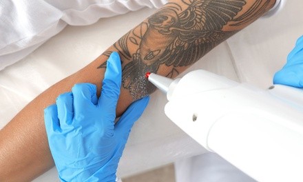 Three Tattoo-Removal Sessions on An Area up to 5, 10, or 15 Square Inches at Beauty Luxe (Up to 83% Off)