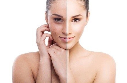 One or Three Chemical Peels at LoveLee 4Life (Up to 43% Off)