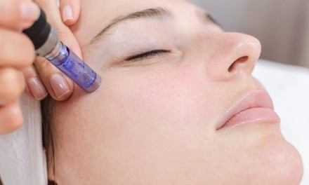 One Microneedling Sessions With Optional PRP at PSRx Body and Skin (Up to 73% Off)