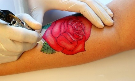 Laser Tattoo Removal at Magnolia Medical And Aesthetics (Up to 72% Off). Four Options Available.