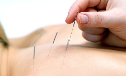 Up to 52% Off on Acupuncture Services at SDR Healing Acupuncture