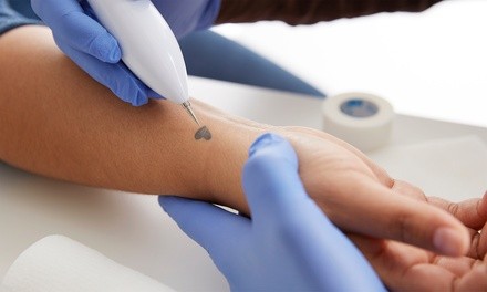 Three Tattoo-Removal Sessions on Area Up to 1, 3, or 6 Square Inches at Noble Cosmetic Surgery (Up to 84% Off)