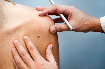 One, Two, or Three Skin Tag, Mole, or Age Spot Removals at Tru Reflections Advanced Medical Spa (Up to 77% Off)