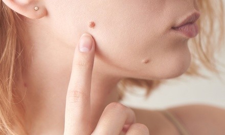 One to Three or Five Skin Tag Removals at Doors To Heaven Spa (Up to 59% Off)