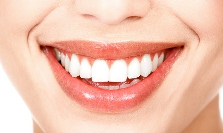 $73.12 for a Dental Package with Custom Bleaching Trays, Exam, and X-rays at Mission Boulevard Dental Group ($505 Value)