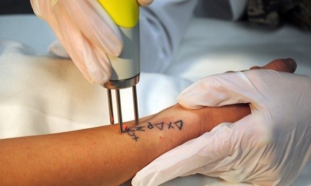 Tattoo or Permanent Makeup Removal at Monique's Body Art (Up to 72% Off). Seven Options Available.