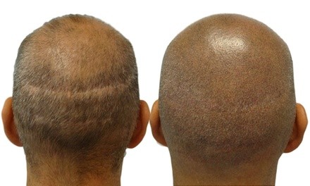 One Hair-Restoration Micropigmentation Session at Laser XT (Up to 50% Off). Three Options Available.