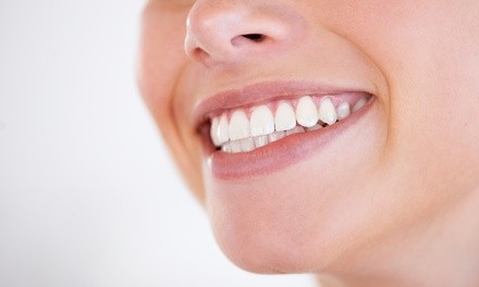 Porcelain Veneers or Take-Home Teeth Whitening Kit with Add-On at Scarsdale Personal Dental Care (Up to 31% Off)