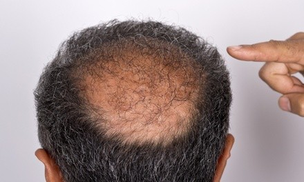 50% Off Hair Restoration - Other