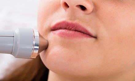 One or Three Microneedling Sessions with Peptide Enzymes and Hylauronic Acid at Renuev Spa (Up to 61% Off)