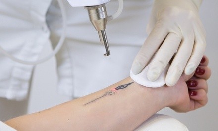 Up to 50% Off on Tattoo Removal at Dr Laser Llc