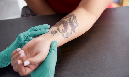 Small, Medium, or Large Tattoo Removal at Acclaim Dermatology (Up to 82% Off). Three Options Available.