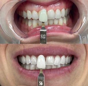 Up to 50% Off on Teeth Whitening - In-Office - Non-Branded at Enhanced by Mel