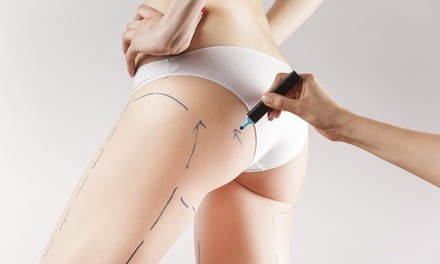 Laser Liposuction Treatments at L. Marcel Body & Wellness Studio (Up to 75% Off). Three Options Available.