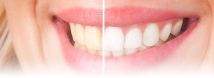 Up to 44% Off on Teeth Whitening - In-Office - Non-Branded at You Should Smile