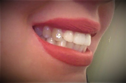 Up to 50% Off on Teeth Whitening - In-Office - Non-Branded at Day Dream Studios