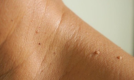 Up to 13% Off Mole / Growth Removal at Dermatown Medical Spa