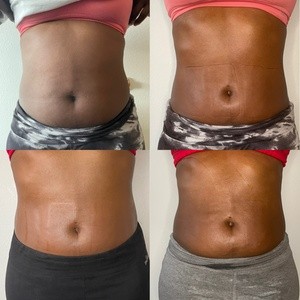 Up to 66% Off on Ultrasonic Fat Reduction at Stuckupclub body sculpting