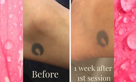 Up to 60% Off on Tattoo Removal at Perfect Match Tattoo