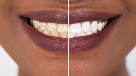 Up to 49% Off on Teeth Whitening - Traditional at Natara Haus