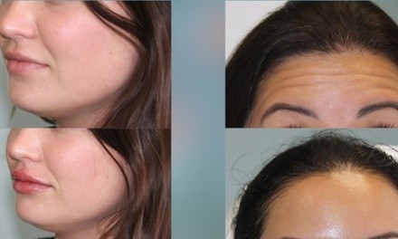 20 Units of Botox and Optional 0.5 ml of Juvéderm Volbella XC at Prestige Aesthetics Clinic (Up to 43% Off)