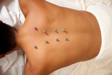 Up to 53% Off on Acupuncture Services at CN Acupuncture Clinic