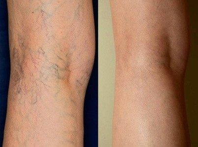 Up to 64% Off on Spider Vein Removal at TLC SELFCARE LLC