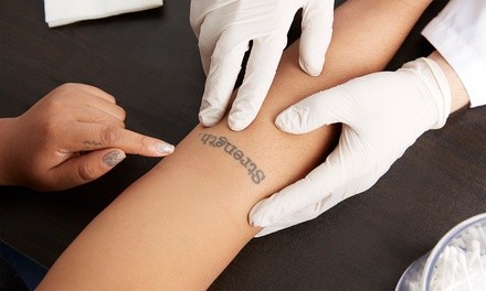 Tattoo-Removal Sessions at AeLeeMD Plastic Surgery and Laser Center (Up to 45% Off). Six Options Available.