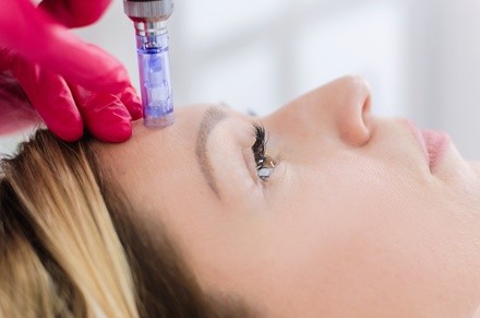 Up to 64% Off on Micro-Needling at Skin & Beauty Boutique