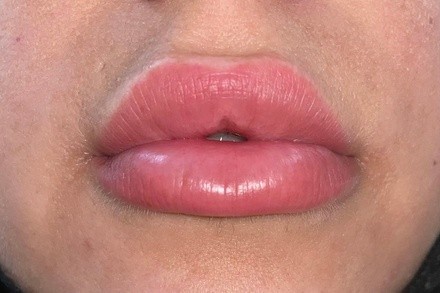 Up to 44% Off on Lip Enhancement at K. Sage Beauty