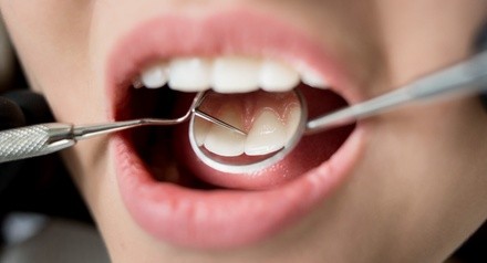 Up to 88% Off on Dental Checkup (Cleaning, X-Ray, Exam) at Elite Dental Care