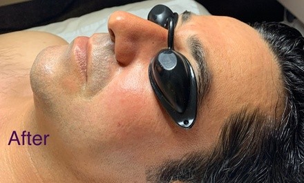 Up to 56% Off on Facial - Anti-Aging at Advanced Aesthetic By Anita