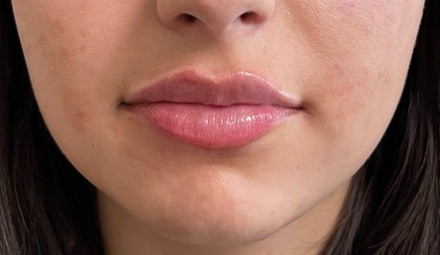 Up to 47% Off on Lip Enhancement at Bioaesthetic by Dr.Castellanos