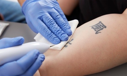 One or Three Tattoo-Removal Sessions at Beauty Lounge Sovana (Up to 66% Off). Three Options Available.
