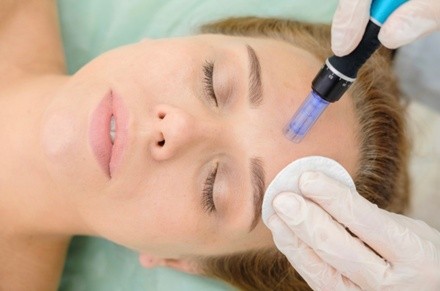 Up to 60% Off on Micro-Needling at Around The Body Skin Solutions