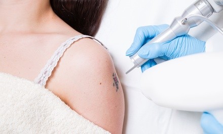 Up to 52% Off on Tattoo Removal at SC Laser Spa, LLC