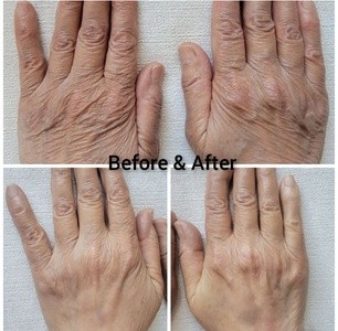 Up to 36% Off on Hand Rejuvenation at Dermapure, LLC