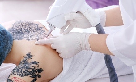 One Tattoo-Removal Session at Riposo Medical Spa (Up to 34% Off). Five Options Available.
