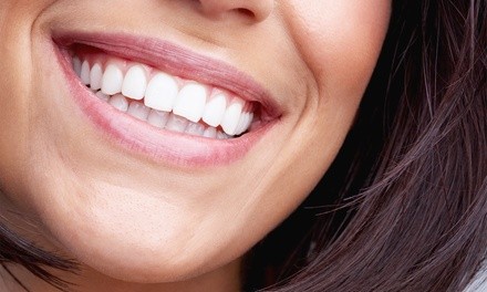 Up to 50% Off on Teeth Whitening - In-Office - Non-Branded at Posh Retreat Day Spa