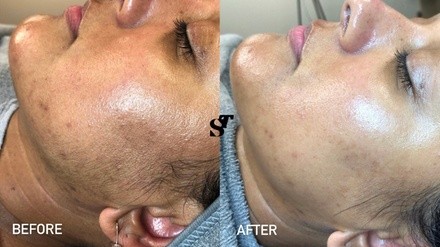 Up to 37% Off on Facial - Chemical Peel at Skin Therapy